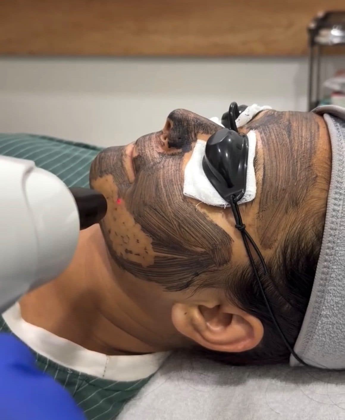 Carbon laser facial treatment