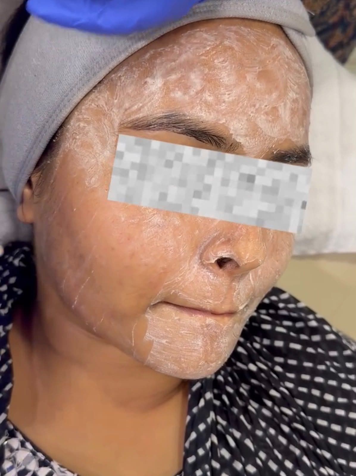 Chemical peel treatment