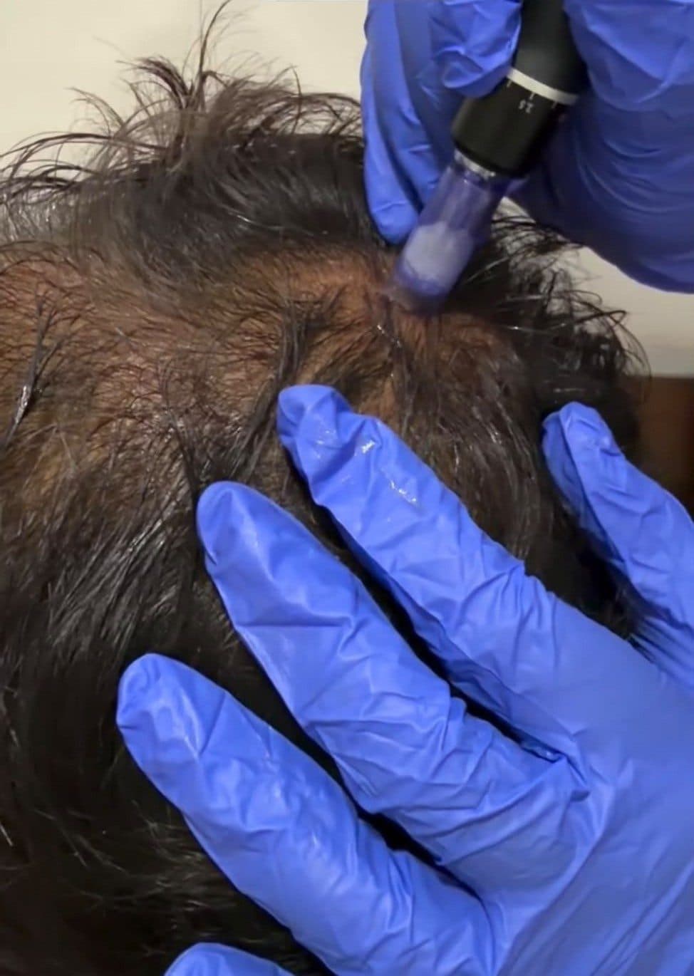 Hair fall treatment