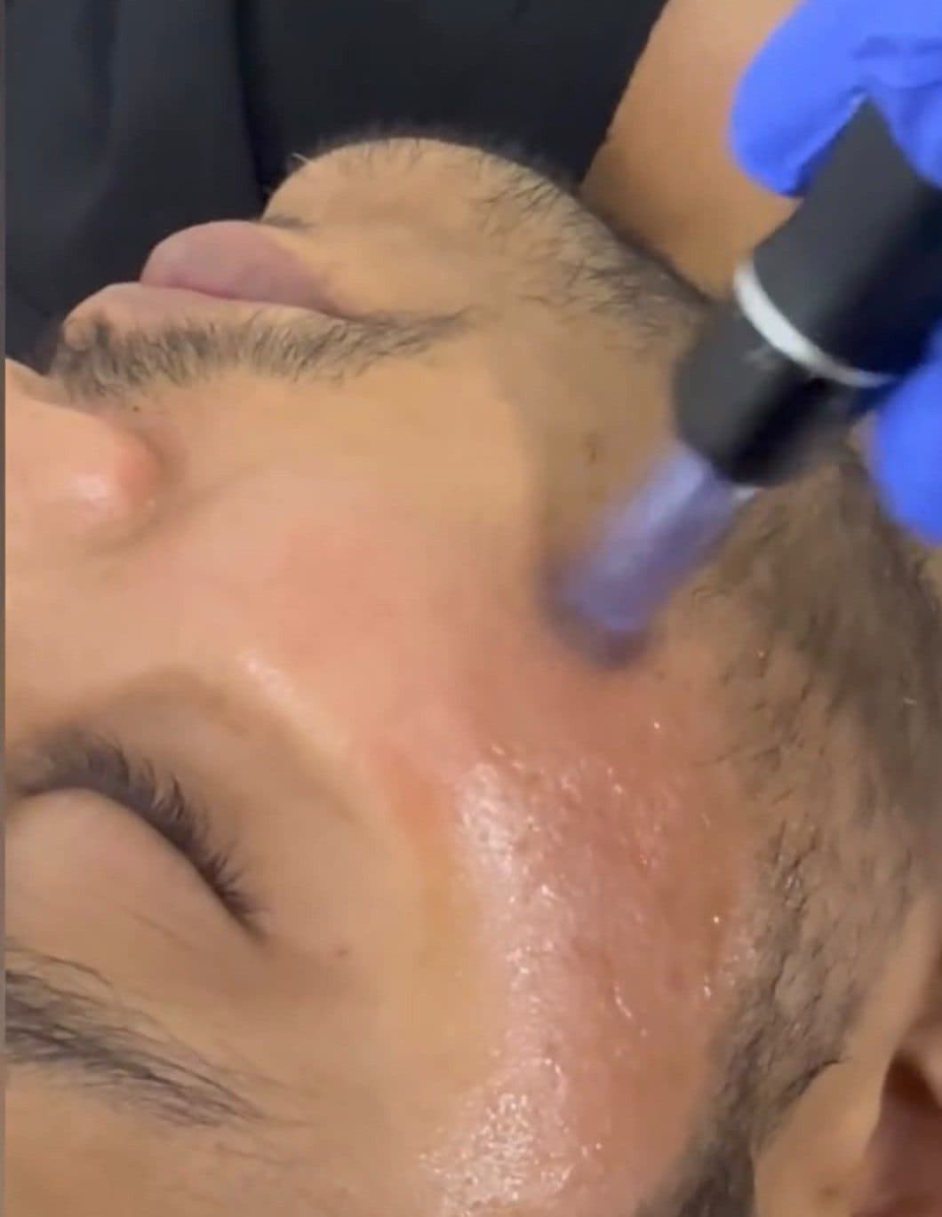 Skin treatment for open pores
